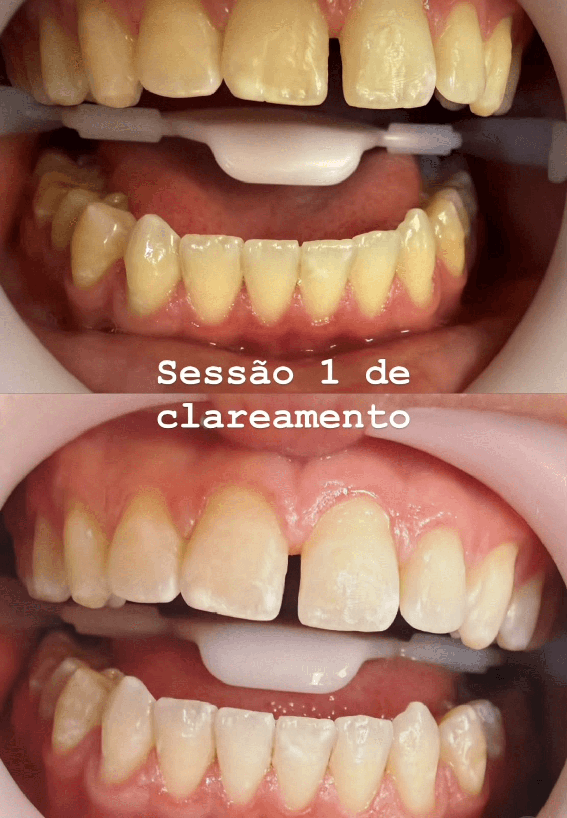 Reabilitação Oral Completa